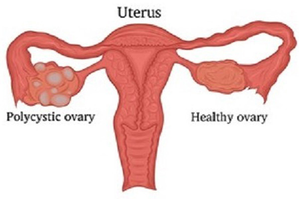 Polycystic Ovarian Disease